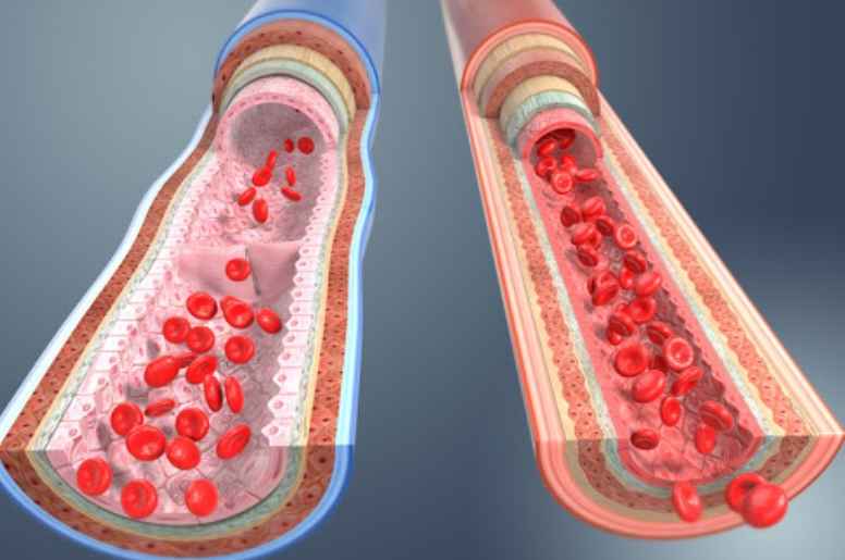 HDL콜레스테롤 낮으면
