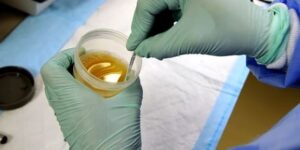 단백뇨 소변검사