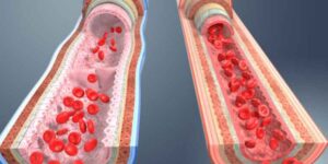 HDL콜레스테롤 낮으면